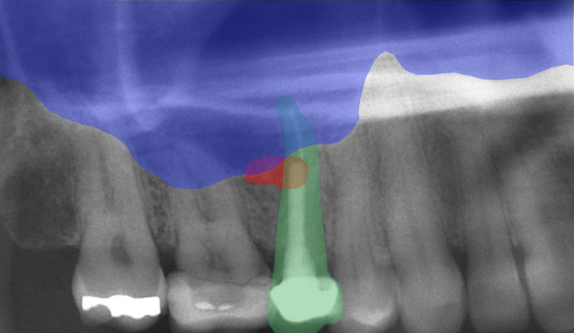 chronic sinus